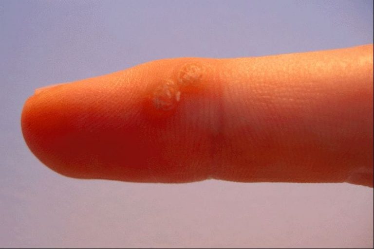 This is how you can remove a small wart without any pain