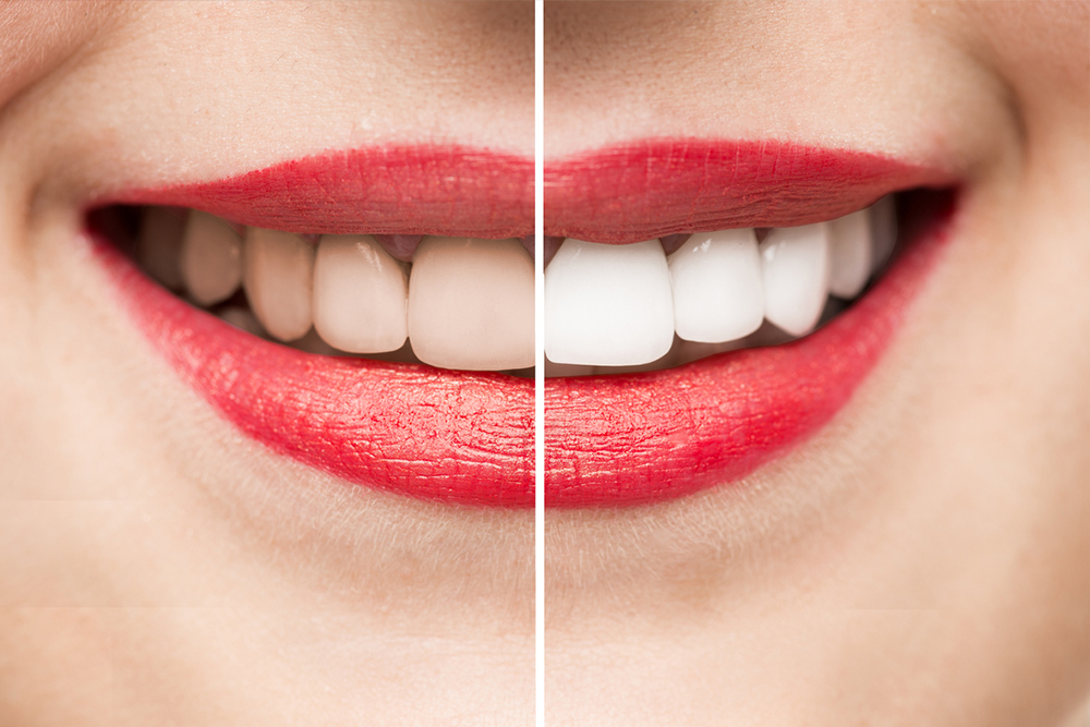 10 Natural Ways To Whiten Your Teeth At Home